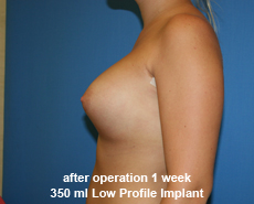 plastic-surgery-breast-augmentation